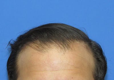 Male Hair Transplant Before & After Gallery - Patient 413388 - Image 2