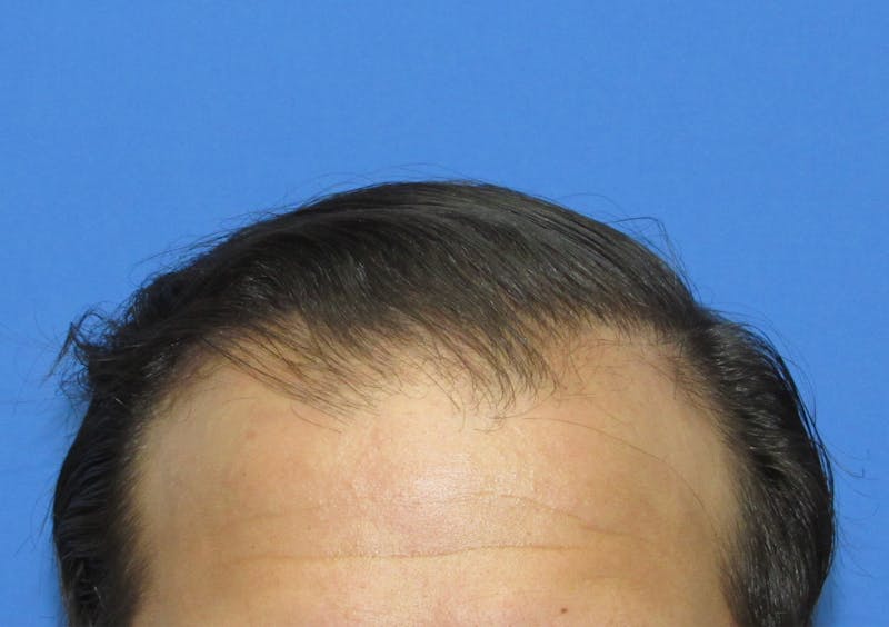 Male Hair Transplant Before & After Gallery - Patient 413388 - Image 2