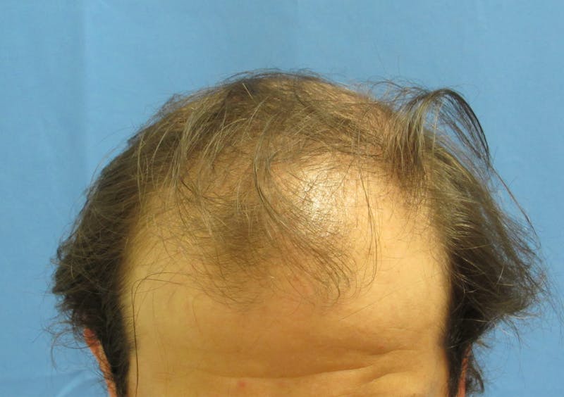 Male Hair Transplant Before & After Gallery - Patient 413388 - Image 3