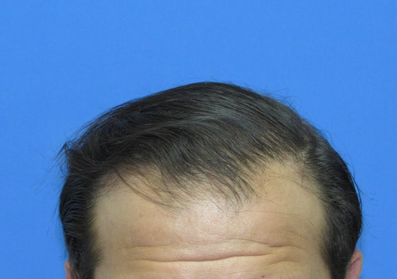 Male Hair Transplant Before & After Gallery - Patient 413388 - Image 4