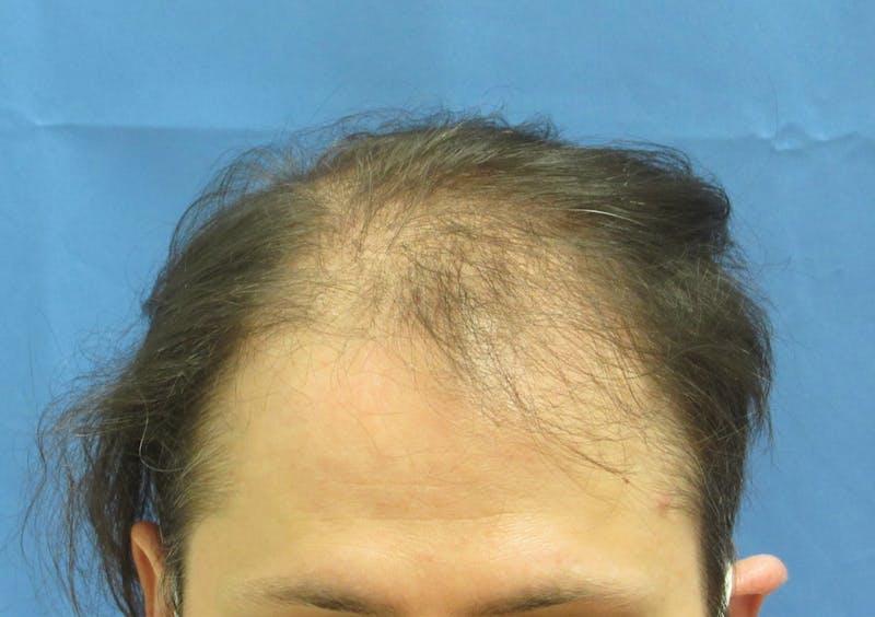 Male Hair Transplant Before & After Gallery - Patient 164141 - Image 1