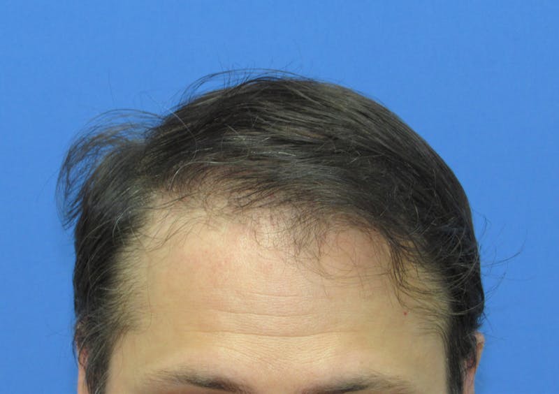 Male Hair Transplant Before & After Gallery - Patient 164141 - Image 2