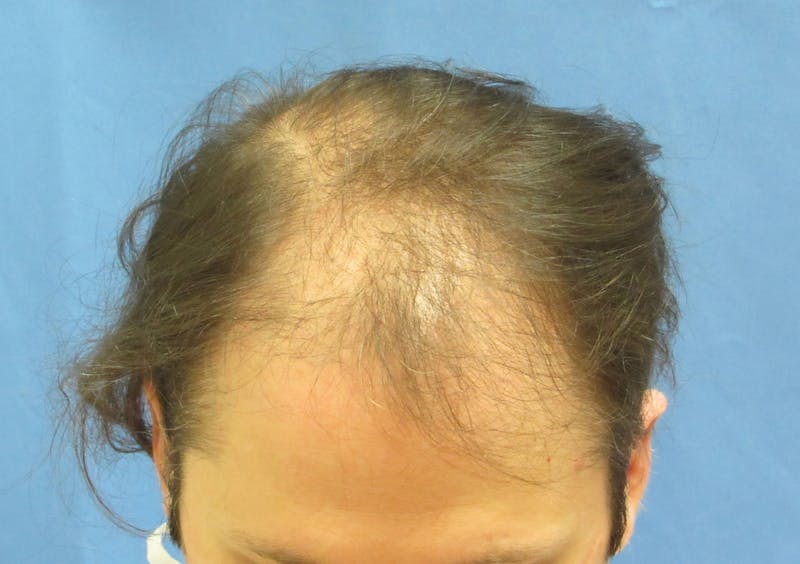 Male Hair Transplant Before & After Gallery - Patient 164141 - Image 3