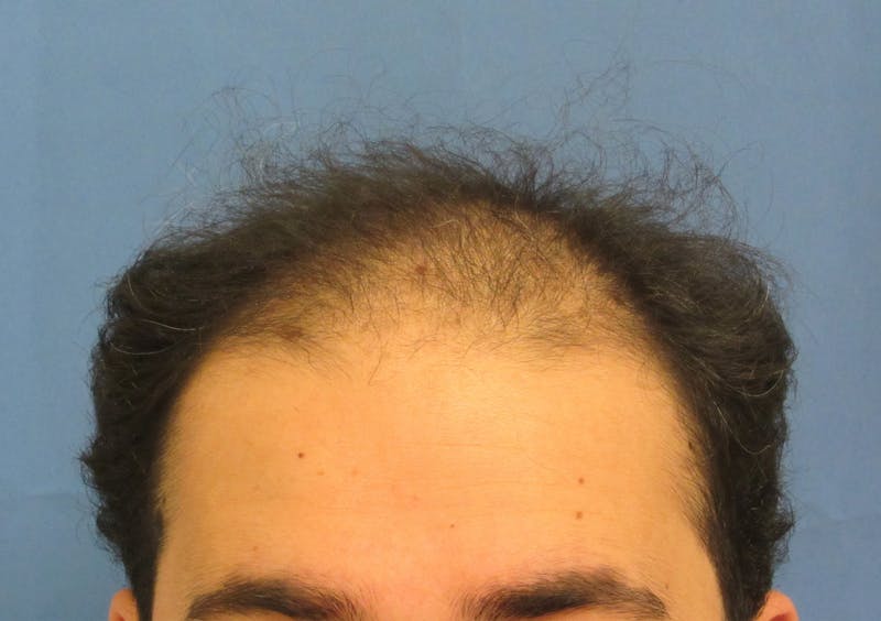 Male Hair Transplant Before & After Gallery - Patient 312672 - Image 1