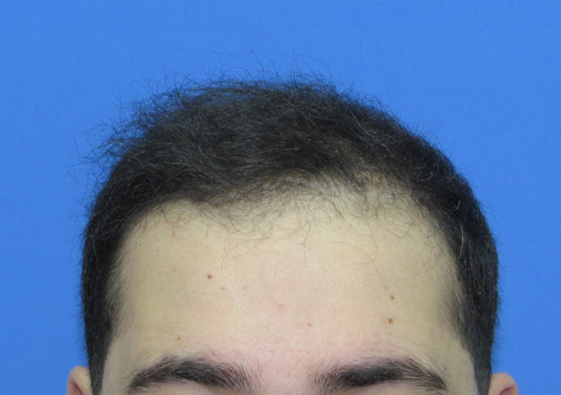 Male Hair Transplant Before & After Gallery - Patient 312672 - Image 2