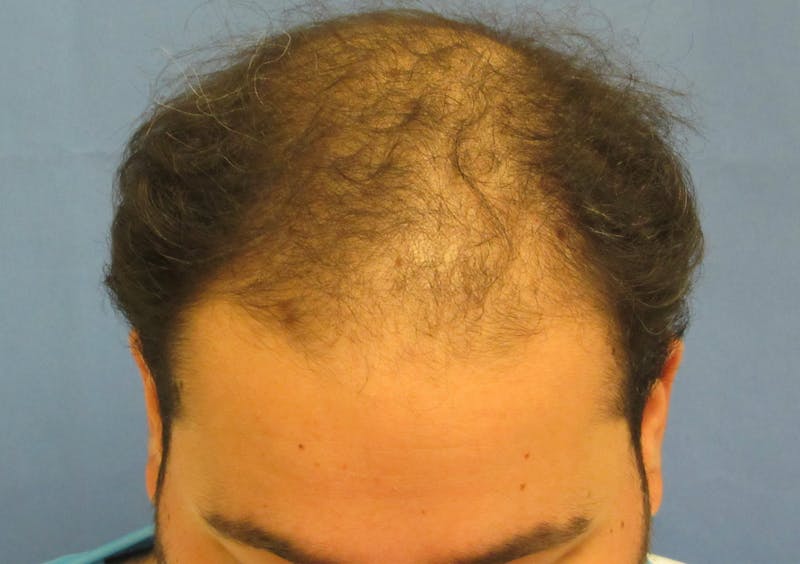 Male Hair Transplant Before & After Gallery - Patient 312672 - Image 3