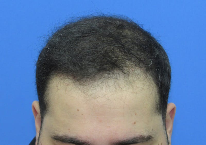 Male Hair Transplant Before & After Gallery - Patient 312672 - Image 4