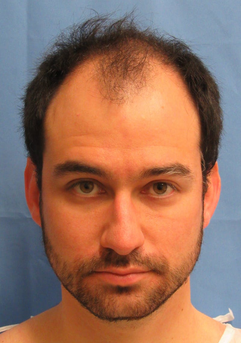 Male Hair Transplant Before & After Gallery - Patient 308587 - Image 1