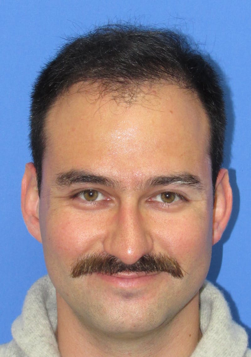 Male Hair Transplant Before & After Gallery - Patient 308587 - Image 2