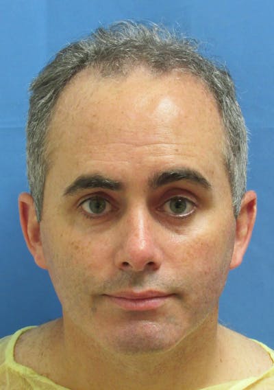 Male Hair Transplant Before & After Gallery - Patient 763652 - Image 1