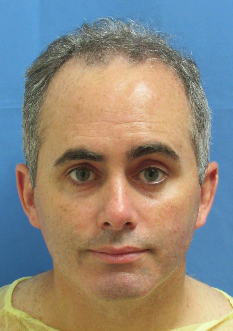 Male Hair Transplant Before & After Gallery - Patient 763652 - Image 1