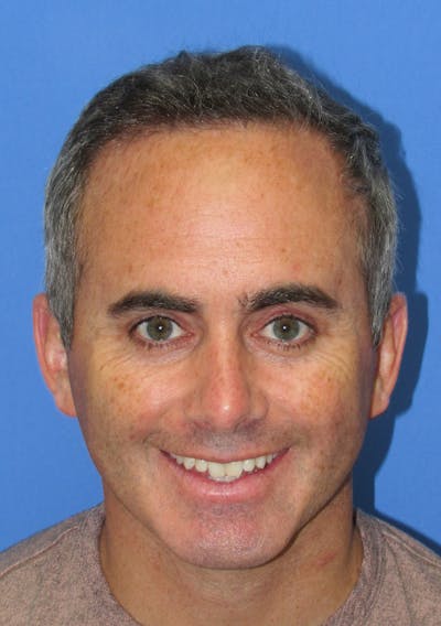Male Hair Transplant Before & After Gallery - Patient 763652 - Image 2