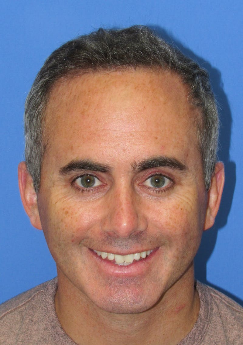 Male Hair Transplant Before & After Gallery - Patient 763652 - Image 2