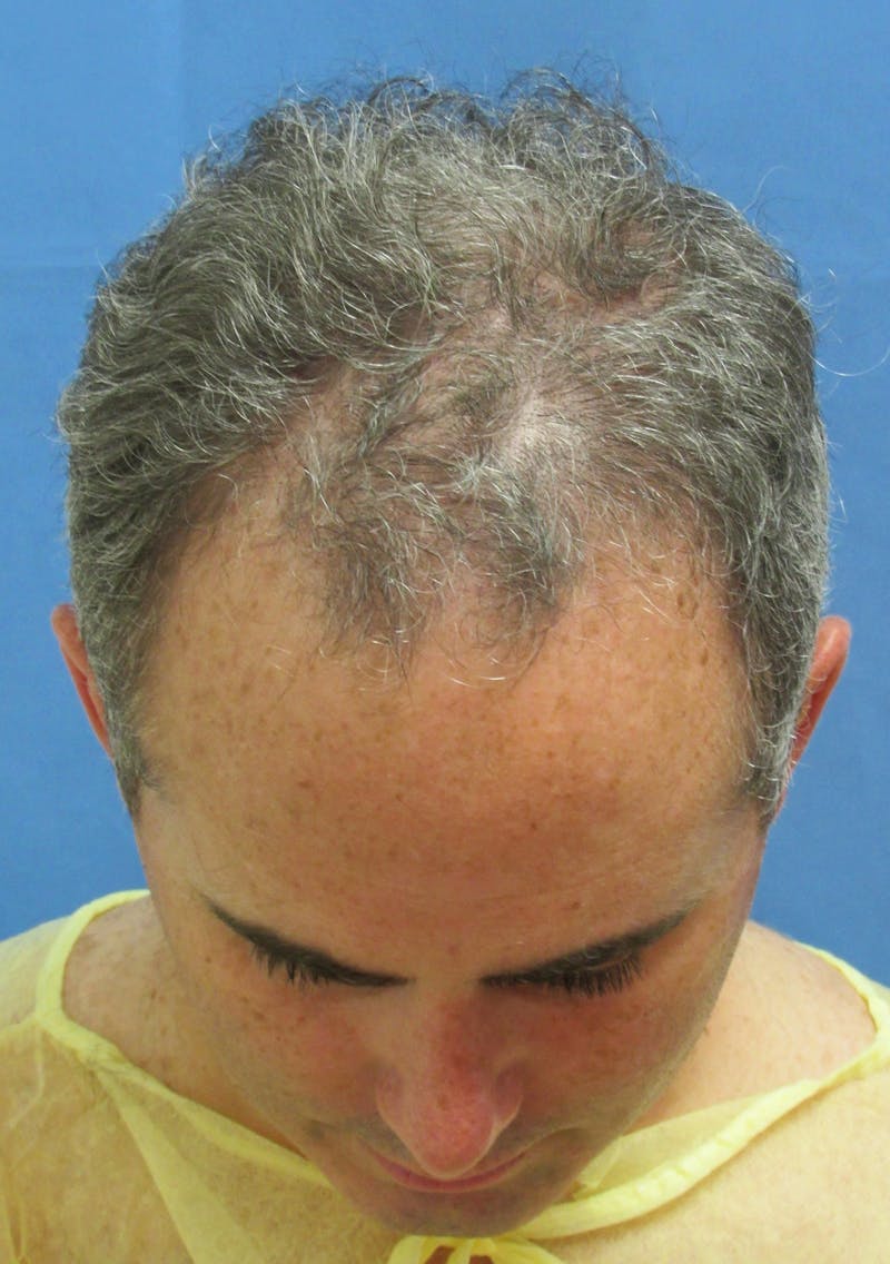 Male Hair Transplant Before & After Gallery - Patient 763652 - Image 3
