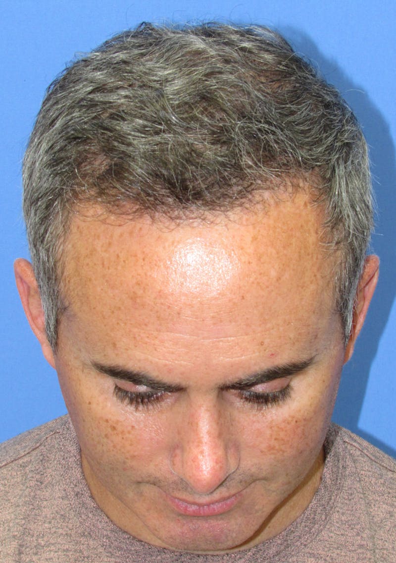 Male Hair Transplant Before & After Gallery - Patient 763652 - Image 4