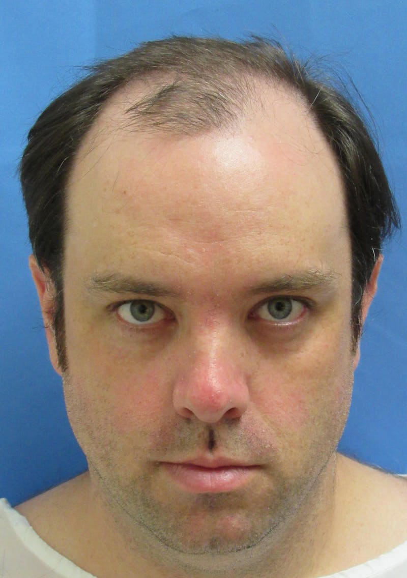 Male Hair Transplant Before & After Gallery - Patient 306778 - Image 1
