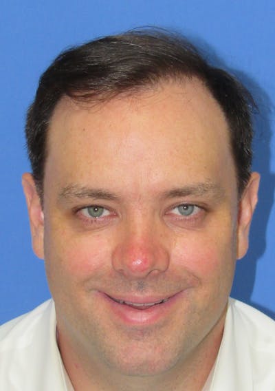 Male Hair Transplant Before & After Gallery - Patient 306778 - Image 2