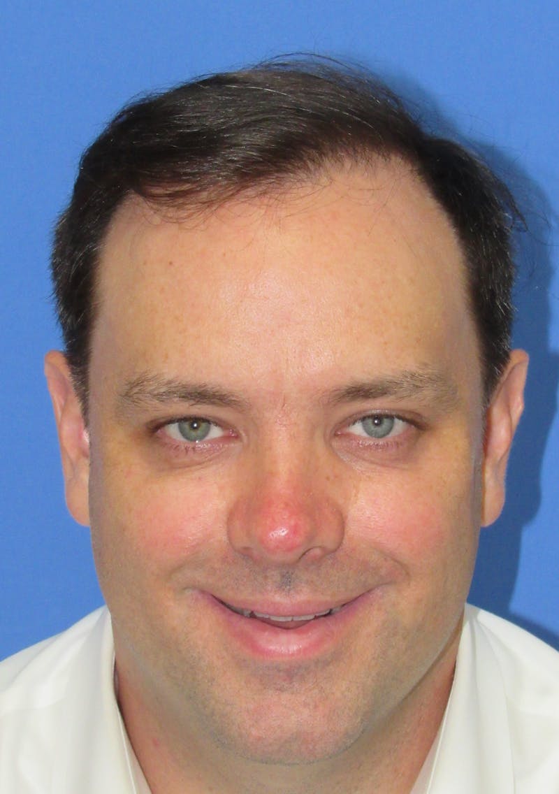 Male Hair Transplant Before & After Gallery - Patient 306778 - Image 2