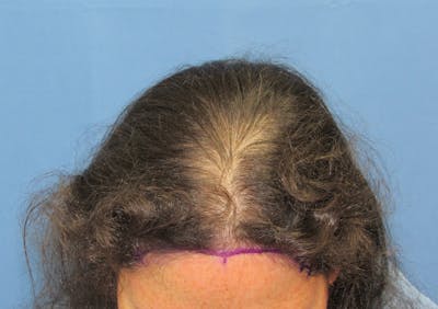 Female Hair Transplant Before & After Gallery - Patient 156476 - Image 1