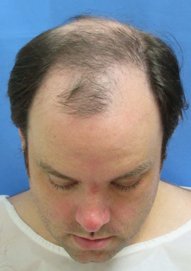 Male Hair Transplant Before & After Gallery - Patient 306778 - Image 3