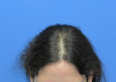 Female Hair Transplant Before & After Gallery - Patient 156476 - Image 2