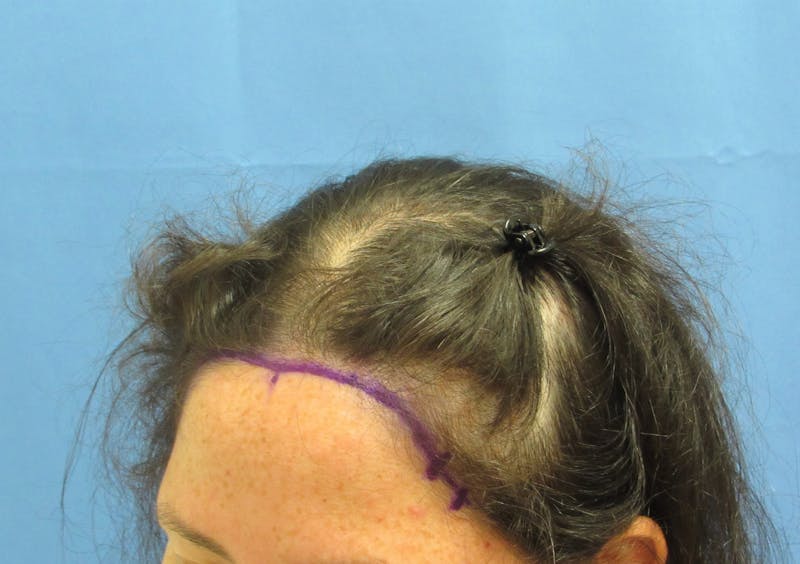 Female Hair Transplant Before & After Gallery - Patient 156476 - Image 3