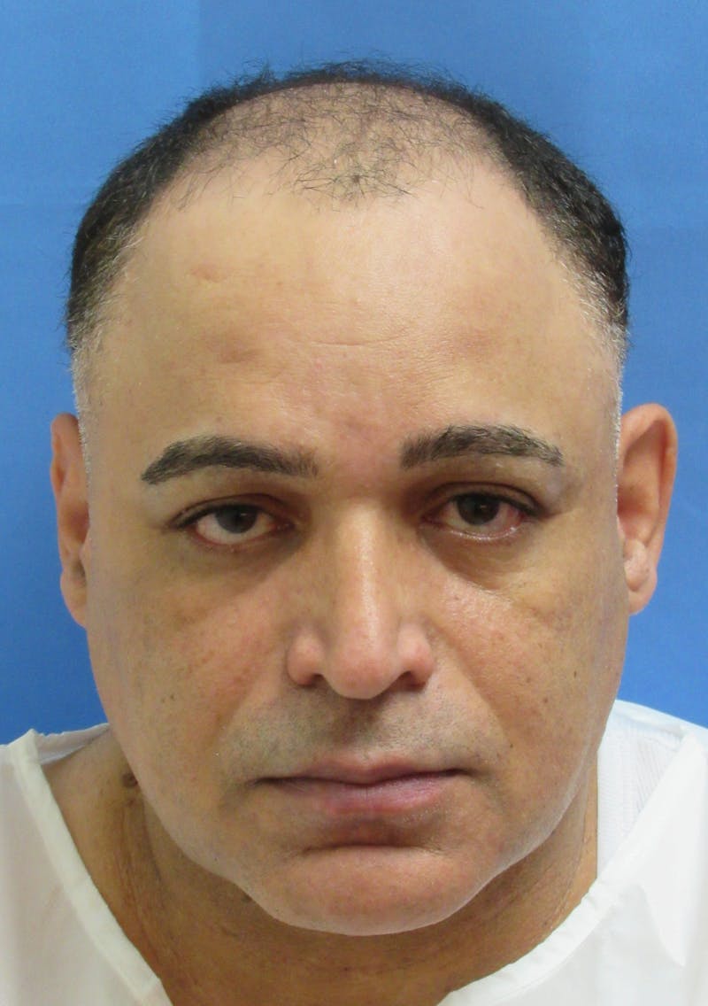 Male Hair Transplant Before & After Gallery - Patient 760063 - Image 1