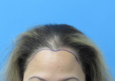 Female Hair Transplant Before & After Gallery - Patient 330397 - Image 1