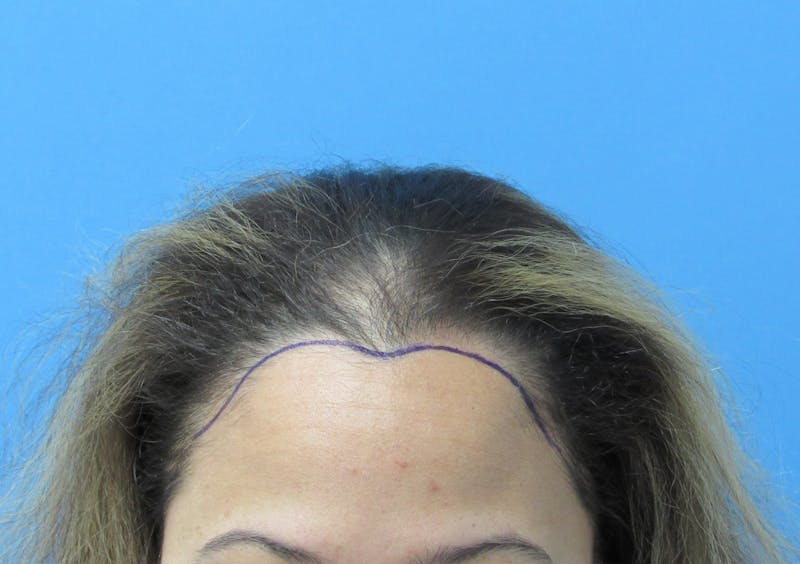 Female Hair Transplant Before & After Gallery - Patient 330397 - Image 1