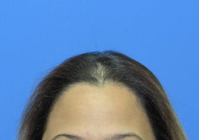 Female Hair Transplant Before & After Gallery - Patient 330397 - Image 2