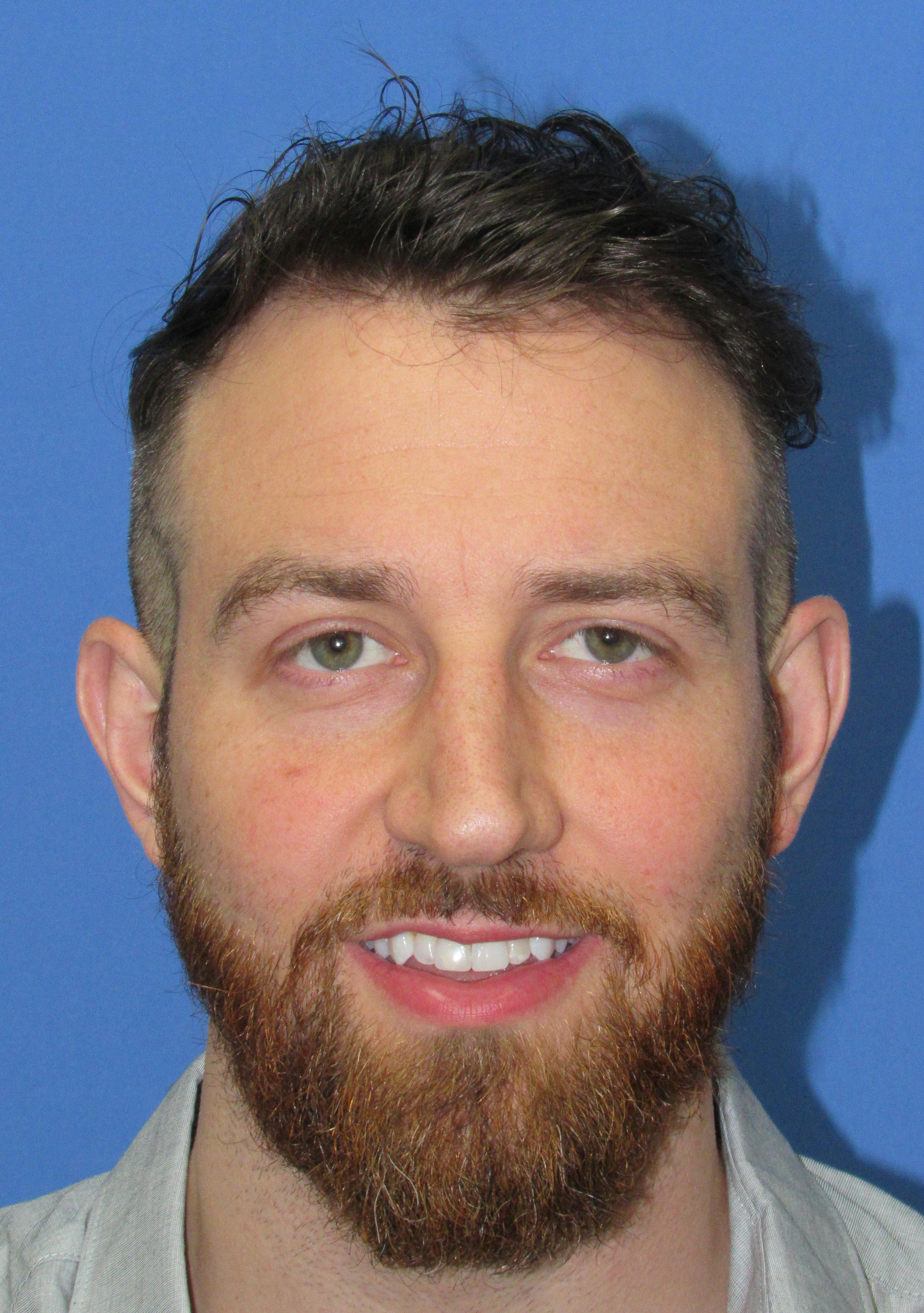 hair restoration patient