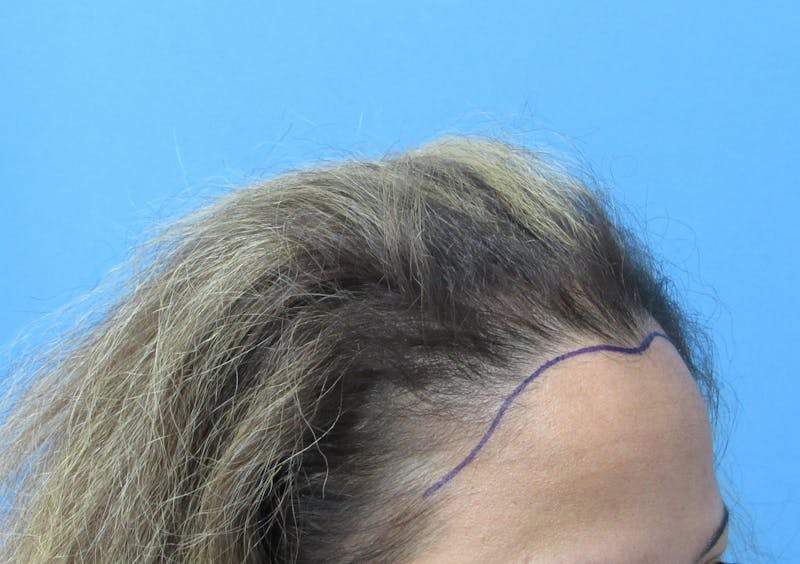 Female Hair Transplant Before & After Gallery - Patient 330397 - Image 3