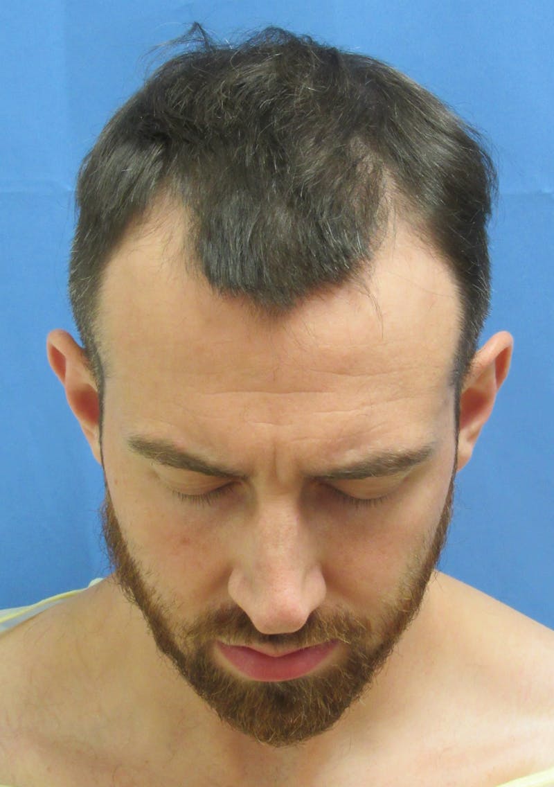 Male Hair Transplant Before & After Gallery - Patient 103905 - Image 3