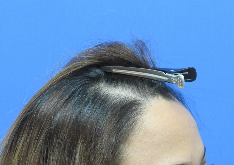 Female Hair Transplant Before & After Gallery - Patient 330397 - Image 4