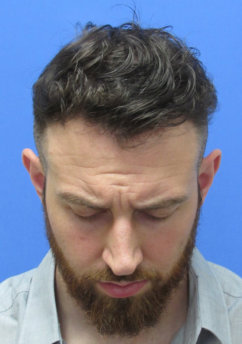 Male Hair Transplant Before & After Gallery - Patient 103905 - Image 4