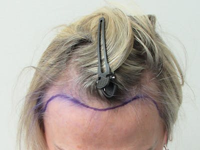 Female Hair Transplant Before & After Gallery - Patient 217060 - Image 1