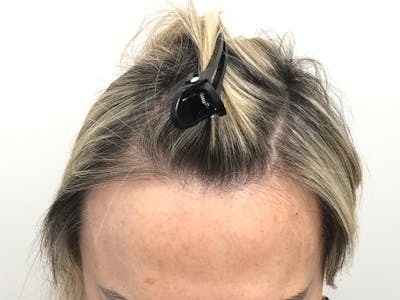 Female Hair Transplant Before & After Gallery - Patient 217060 - Image 2