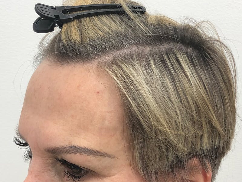 Female Hair Transplant Before & After Gallery - Patient 217060 - Image 4
