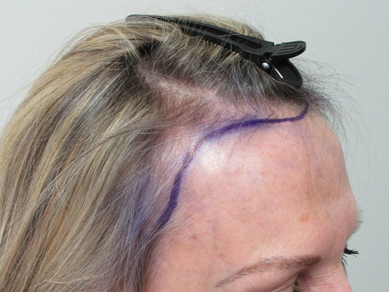 Female Hair Transplant Before & After Gallery - Patient 217060 - Image 5