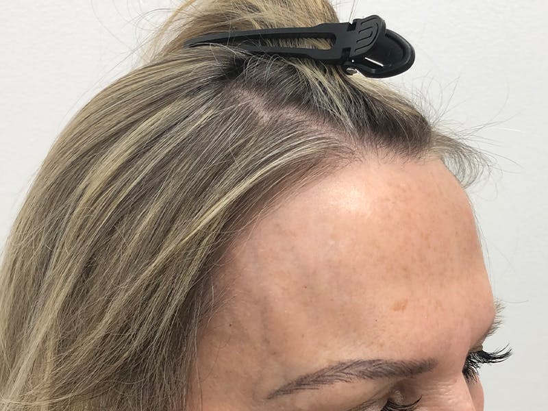 Female Hair Transplant Before & After Gallery - Patient 217060 - Image 6