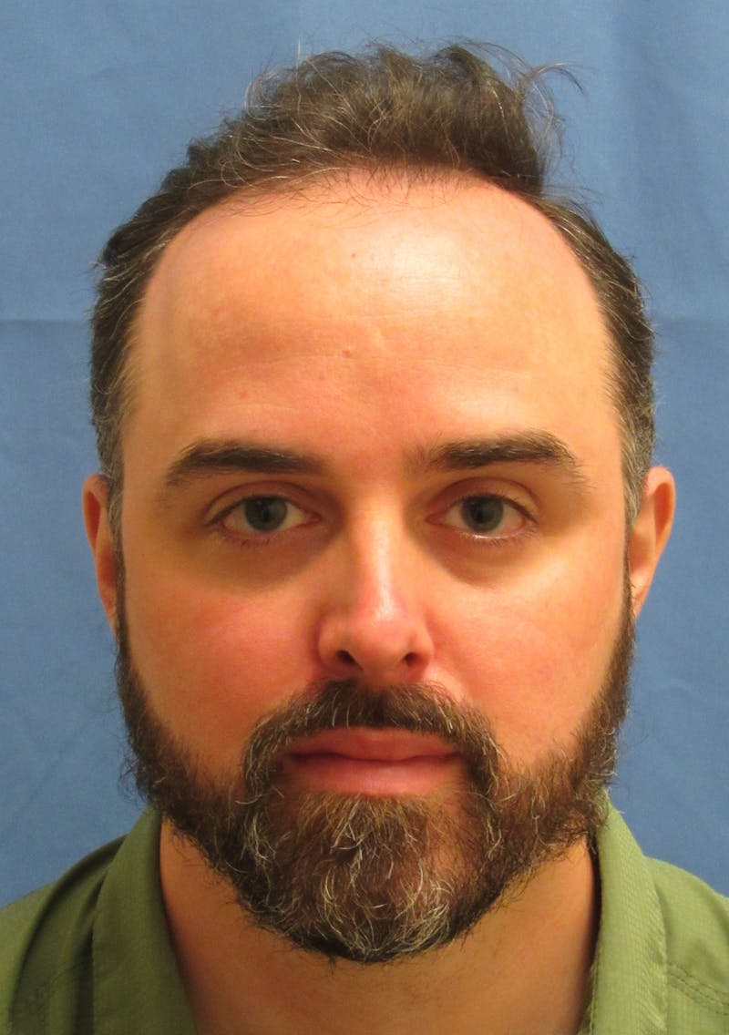 Male Hair Transplant Before & After Gallery - Patient 376750 - Image 1
