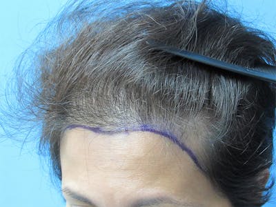 Female Hair Transplant Before & After Gallery - Patient 317877 - Image 1