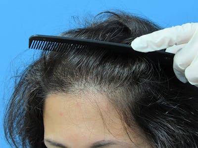 Female Hair Transplant Before & After Gallery - Patient 317877 - Image 2