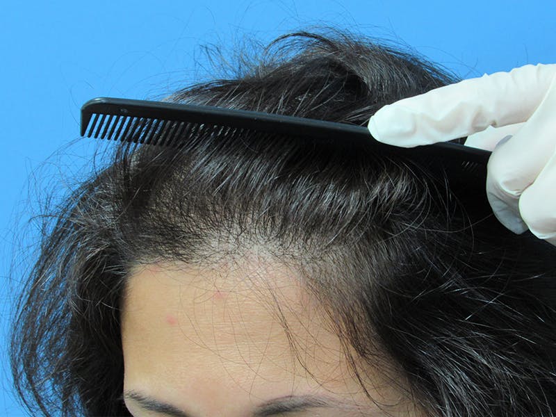 Female Hair Transplant Before & After Gallery - Patient 317877 - Image 2