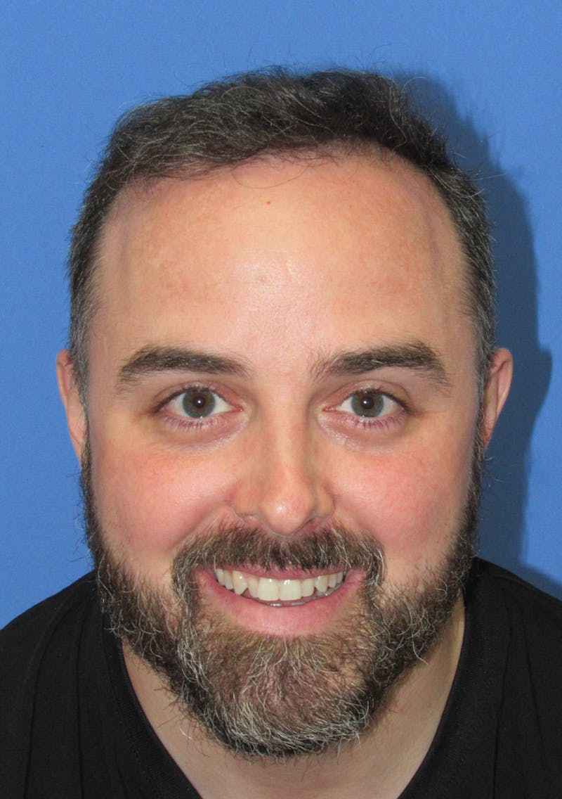 Male Hair Transplant Before & After Gallery - Patient 376750 - Image 2