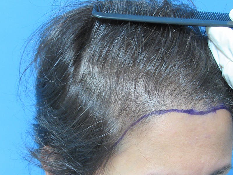 Female Hair Transplant Before & After Gallery - Patient 317877 - Image 3