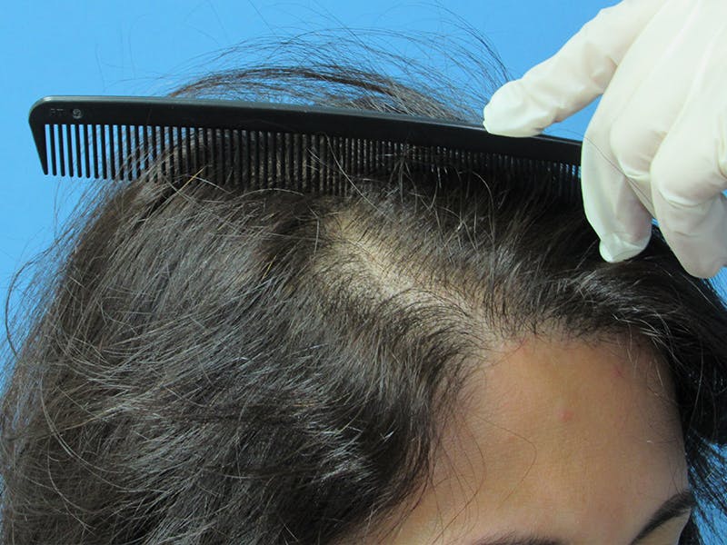 Female Hair Transplant Before & After Gallery - Patient 317877 - Image 4