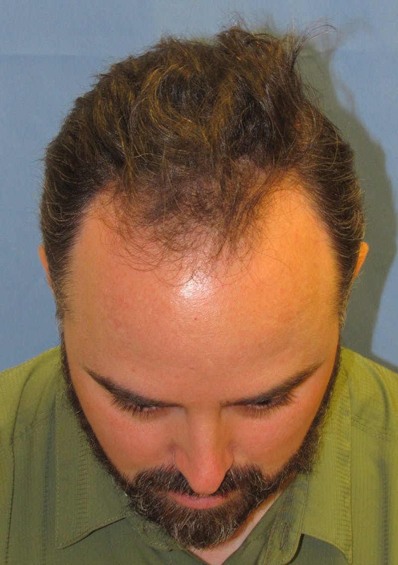 Male Hair Transplant Before & After Gallery - Patient 376750 - Image 3