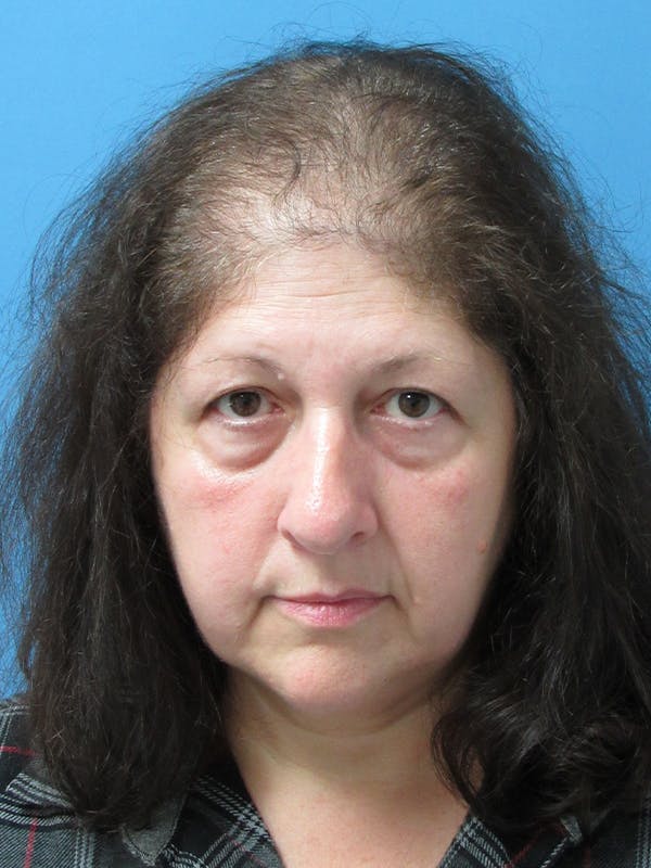 hair restoration patient