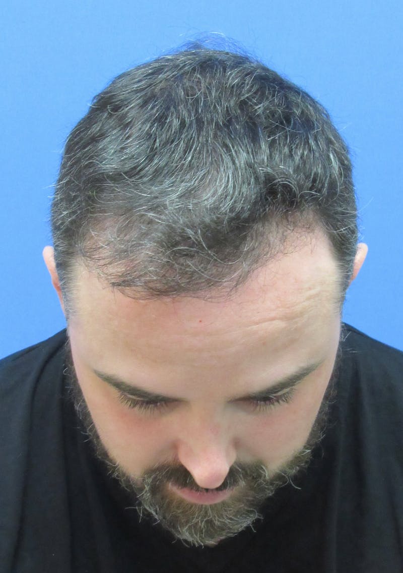 Male Hair Transplant Before & After Gallery - Patient 376750 - Image 4